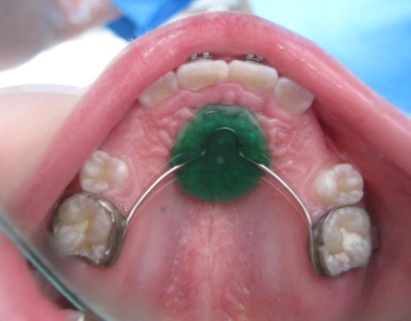 Tratamientos Servicios Dr Eduardo Estupiñan Odontologo Ibague