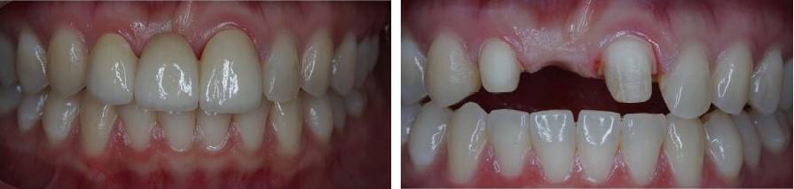 Tratamientos Servicios Dr Eduardo Estupiñan Odontologo Ibague